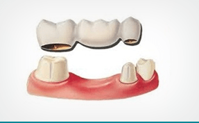 Мостовидные протезы