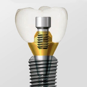 Импланты Biotem, Dentium