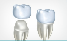 Единичные коронки на зубы из металлокерамики